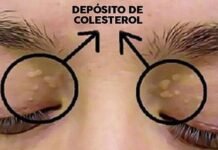 Cuanto tus ojos te dan una señal de colesterol alto