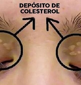Cuanto tus ojos te dan una señal de colesterol alto
