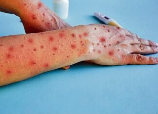 Salud confirma el caso cuatro de viruela del mono